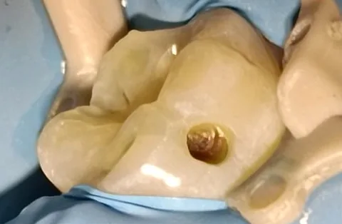 Molar con acceso endodóntico durante el tratamiento de conductos