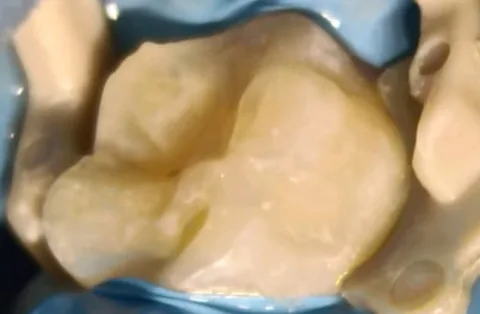 Molar sellado y reconstruido después de la endodoncia