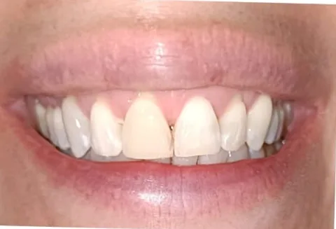 Sonrisa con dientes frontales desgastados y de distinto tono antes del tratamiento