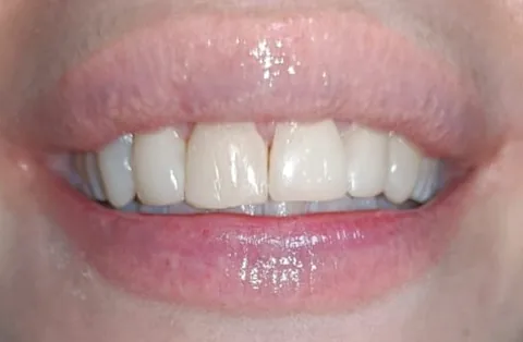 Sonrisa con dientes frontales restaurados de forma estética después del tratamiento