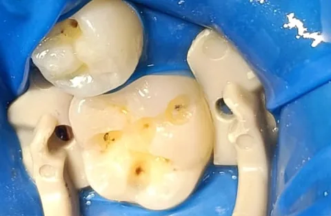 Molar con caries antes de la restauración con resina dental