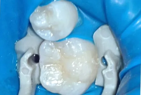 Molar restaurado con resina estética después del tratamiento
